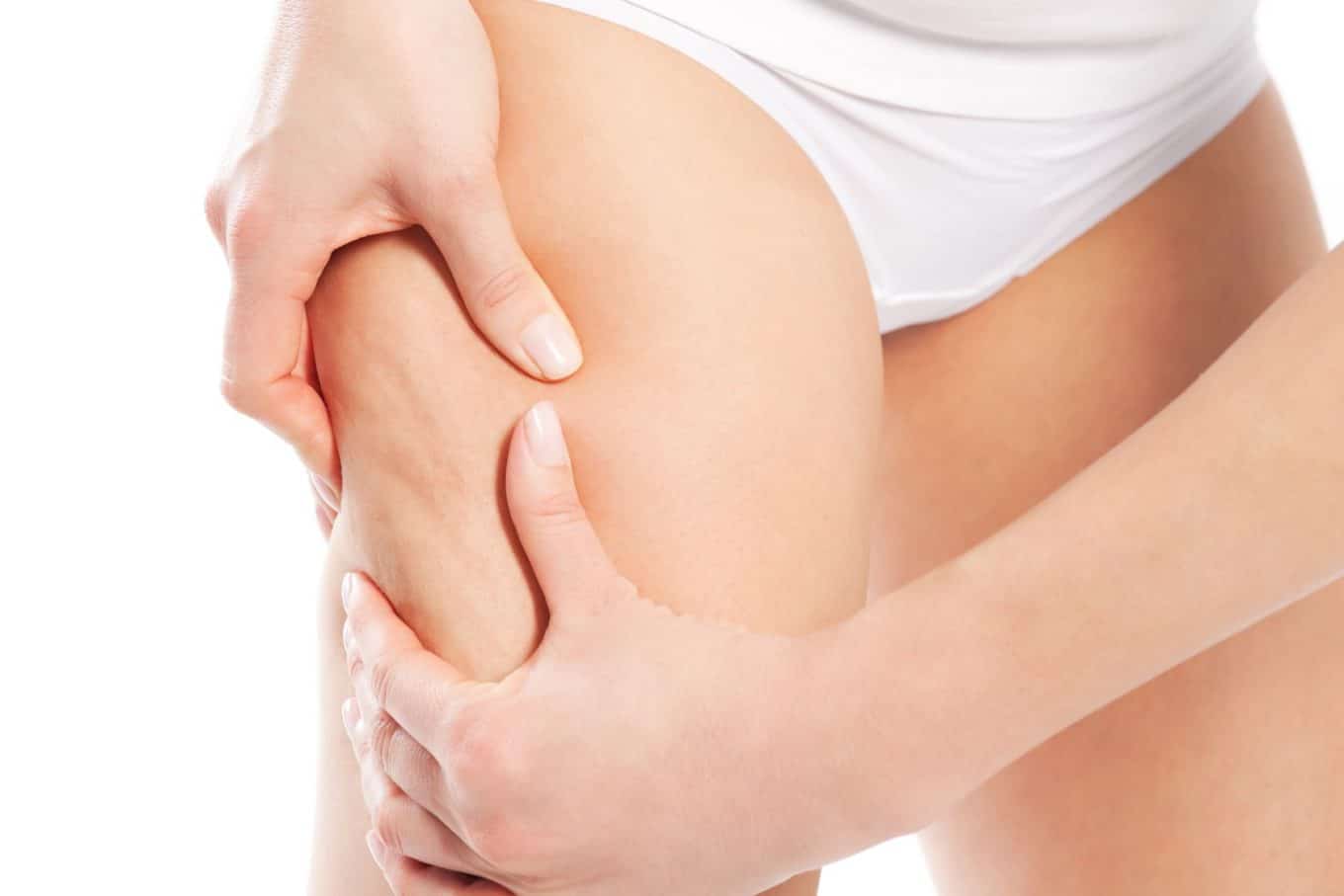 How Can I Get Rid of My Cellulite?-UT-Ruma-Medical How Can I Get Rid of My Cellulite?