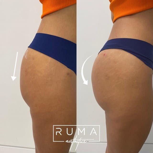 Butt lift with PDO threads | Ruma Medical