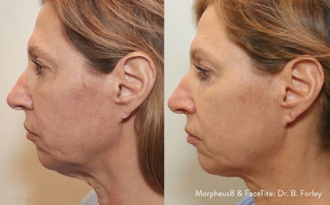 Morpheus 8 Face and Body Morpheus 8 Face and Body