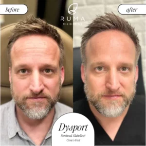 Dysport Treatment Before/After At Ruma Medical