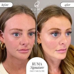 Fillers Treatment Before/After Ruma Medical