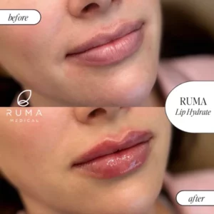 Fillers Treatment Before/After Ruma Medical