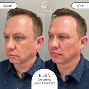 Fillers Treatment Before/After Ruma Medical
