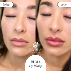 Fillers Treatment Before/After Ruma Medical