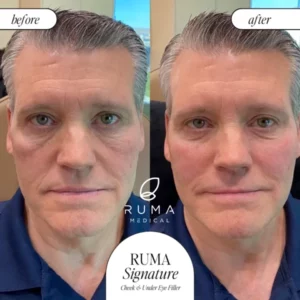 Fillers Treatment Before/After Ruma Medical