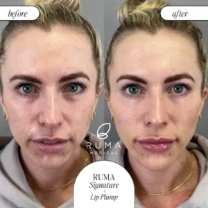 Fillers Treatment Before/After Ruma Medical