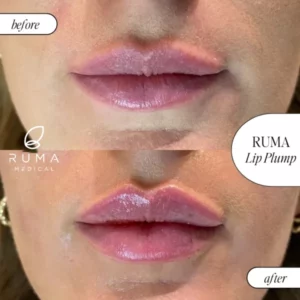 Fillers Treatment Before/After Ruma Medical