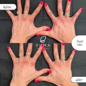 Fillers Treatment Before/After Ruma Medical