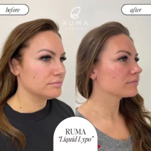 Kybella Treatment Before/After At Ruma Medical