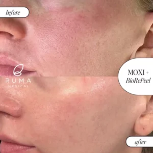 Laser Treatments Before/After At Ruma Medical