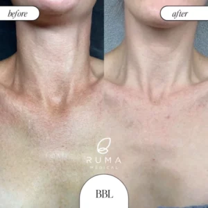 Laser Treatments Before/After At Ruma Medical