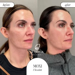 Laser Treatments Before/After At Ruma Medical