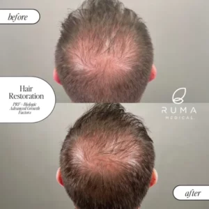 PRP/PRF Treatment Before/After At Ruma Medical