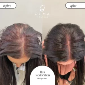 PRP/PRF Treatment Before/After At Ruma Medical