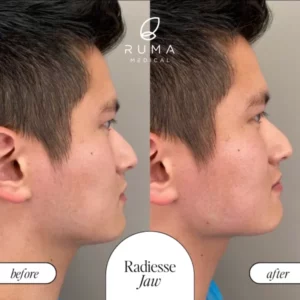 Sculptra Treatment Before/After At Ruma Medical